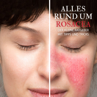 Raphael Kleine-Termeer: Alles Rund um Rosacea - Der kleine Ratgeber mit Tipps und Tricks