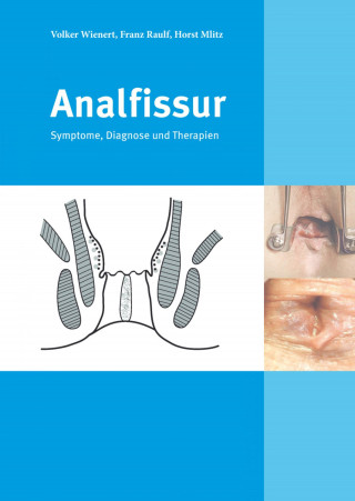 Franz Raulf, Prof. Dr. med. Volker Wienert, Dr. med. Horst Mlitz: Analfissur