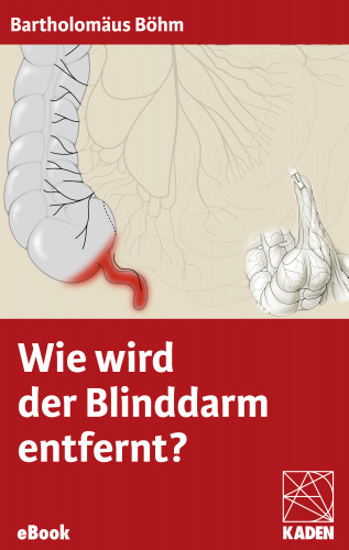 Bartholomäus Böhm: Wie wird der Blinddarm entfernt?