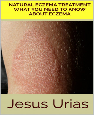 Jesus Urias: Natural Eczema Treatment