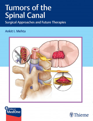 Ankit I. Mehta: Tumors of the Spinal Canal