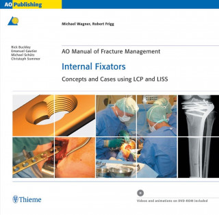 Michael Wagner, Robert Frigg: AO Manual of Fracture Management: Internal Fixators