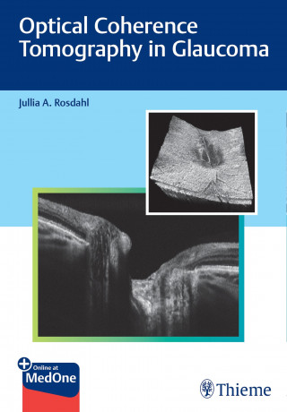 Jullia Rosdahl: Optical Coherence Tomography in Glaucoma