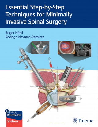 Roger Hartl, Rodrigo Navarro-Ramirez: Essential Step-by-Step Techniques for Minimally Invasive Spinal Surgery