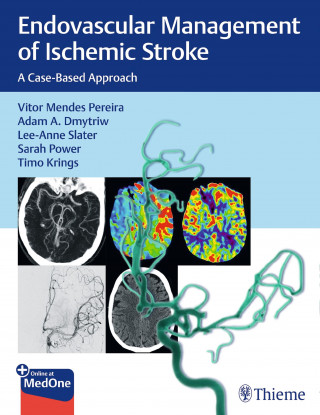 Vitor Pereira, Adam Dmytriw, Lee-Anne Slater, Sarah Power, Timo Krings: Endovascular Management of Ischemic Stroke